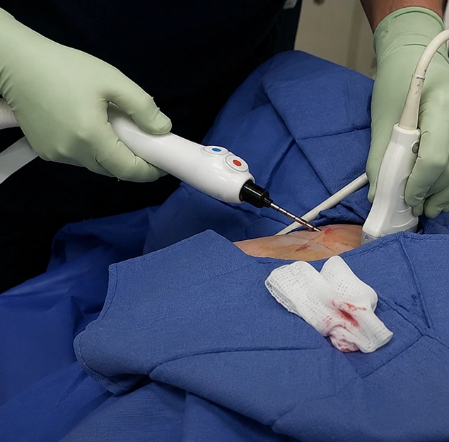 What Happens During Cryoablation?