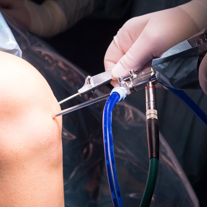 Radiofrequency Ablation