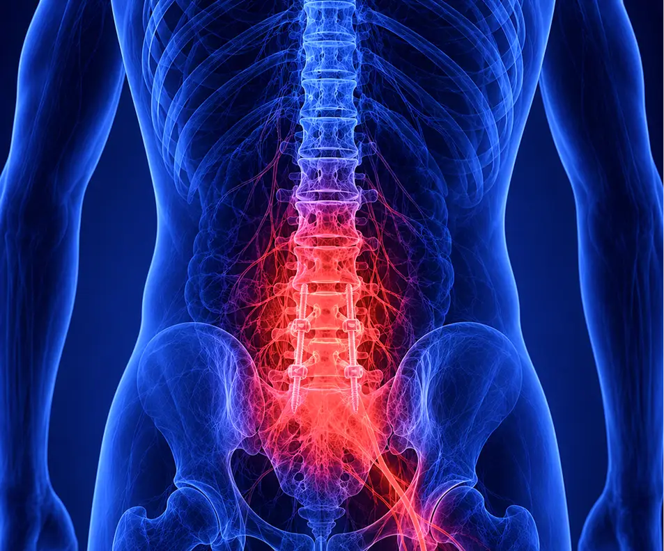 Failed Spine Surgery Syndrome
