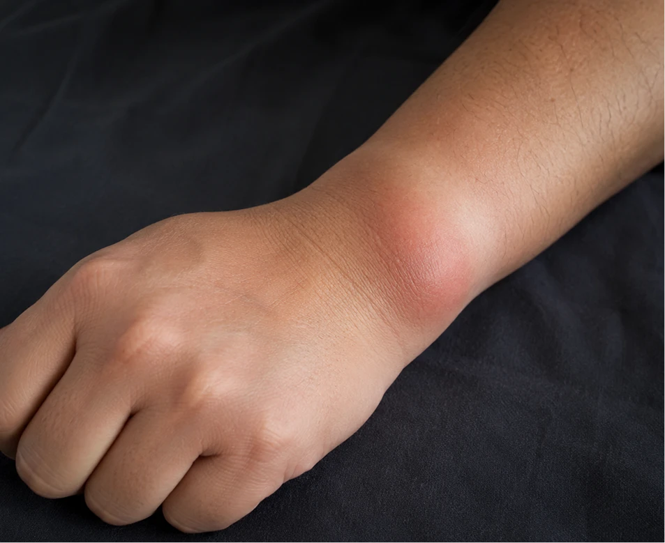 What Are the Symptoms of Osteoarthritis of The Wrist?