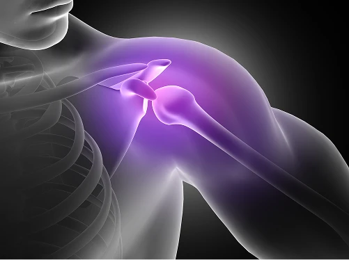 What Is Tendonitis? 