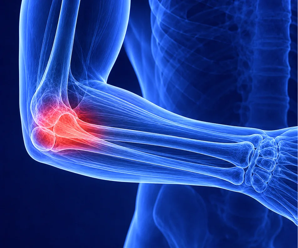 Tennis Elbow