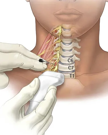 Nerve Blocks