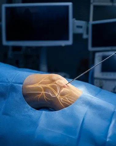 Genicular Radiofrequency Ablation