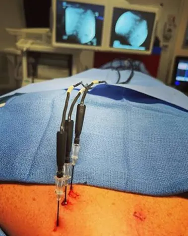 Radiofrequency Ablation