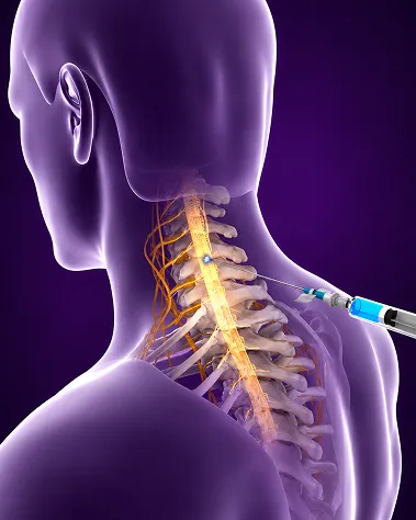 Cervical Epidural Steroid Injections