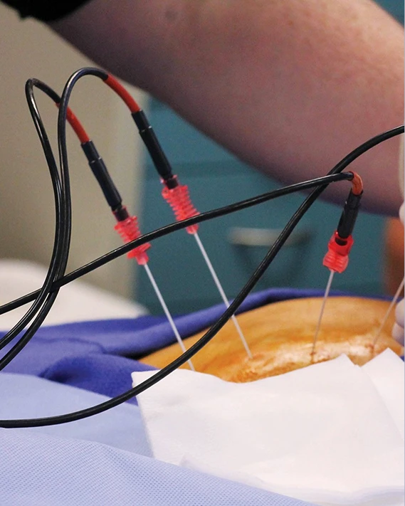 Radiofrequency Ablation